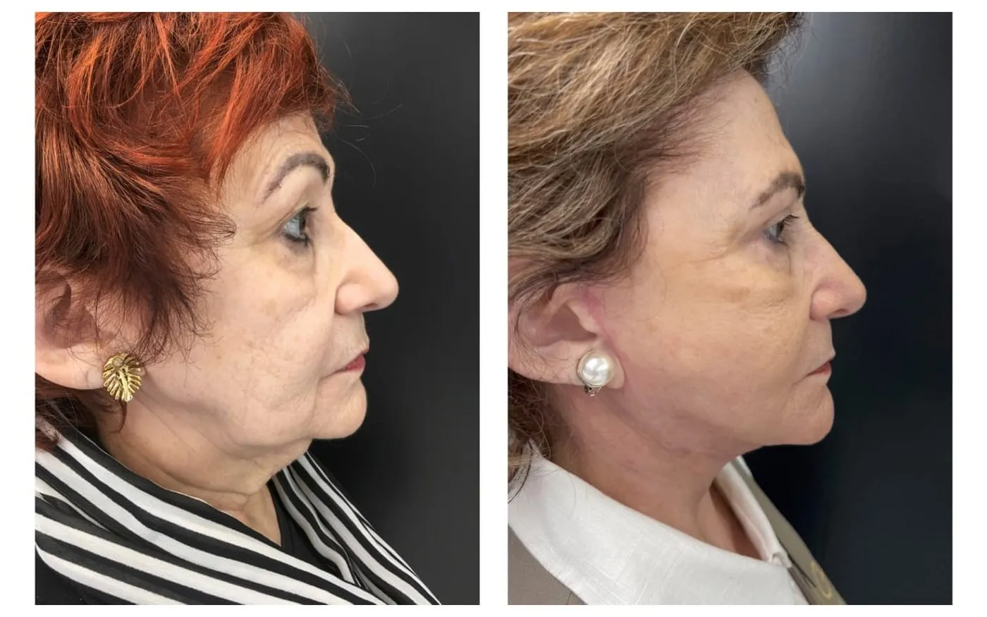 Facelift: foto de antes e depois de paciente real da Clínica Charmant (2)