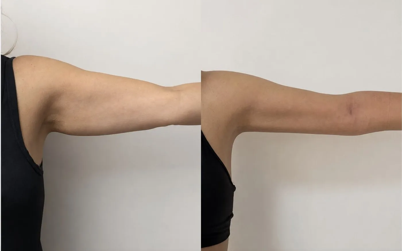 Mini lipo com laser: foto de antes e depois de paciente real da Clínica Charmant (3)
