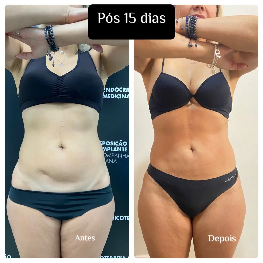 Mini lipo com laser: foto de antes e depois de paciente real da Clínica Charmant (2)